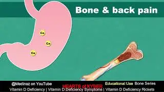 Vitamin D Deficiency by @Medinaz on YouTube FT on Hearts of Kyber   Kyber Cave Productions   Copy