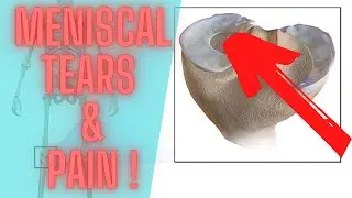 What Are The Different Types Of Meniscus Tears And Why They Cause Pain !