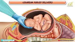 Mastering Caesarean Forceps Delivery: A Step-by-Step 3D Animation Guide