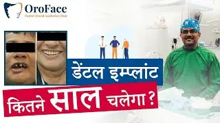 Dental Implant Kitne Saal Chalega? Real Truth & Longevity Explained