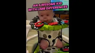 An Awesome Kid With Limb Differences ❤️ | OKAY REALLY