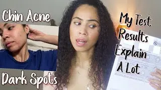 How Hormone Imbalances Causes Acne & How To Treat It Naturally