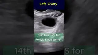 Good Size Follicle to Conceive - 14th Day TVS Ultrasound   #pregnant #infertility #pregnancyjourney