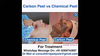 Carbon Peel VS Chemical Peel - Which Is Better ? Best Skin Treatment for Clear Glass Skin