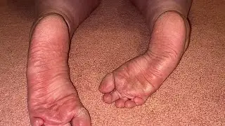Itchy Feet: Itchy Throughout The Day
