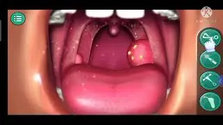 Tonsil surgery