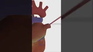 Surge Cardiovascular PEAK Left Heart Vent Cannula Animation