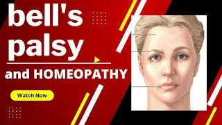 bell's palsy || facial pralysis || best homeopathy medicine for face paralysis !