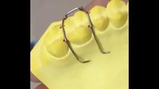 How to Make Adam Clasp in Orthodontics UHS
