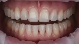 FULL MOUTH REHABILITATION OF POSTERIOR TEETH WITH CERAMIC OVERLAYS AND ONLAYS