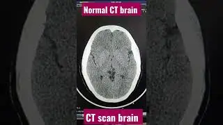 Normal CT scan brain #radiologist #ct #radiology #ctscan