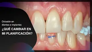 Oclusión: dientes e implantes ¿Qué cambiar en mi planificación? | Milko Villarroel con Armando Badet