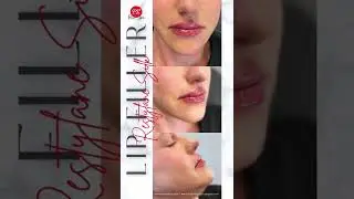 Lip Filler Results with Restylane Silk | PS Med Spa in Houston, TX