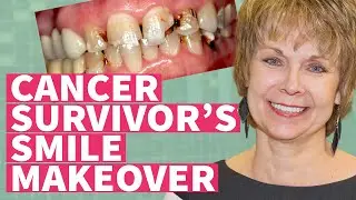 Cancer Survivor&rsquo;s Smile Transformation - Cancer Damaged Teeth - Cosmetic Veneers