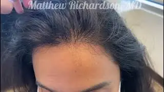 Beautiful 3 month postop forehead reduction results!