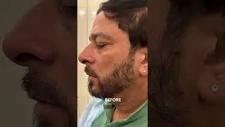 Male Facial Rejuvenation with Fillers + Botox | Dr Athreya Rajagopal - One Aesthetics