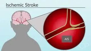 Classification of Stroke by M. Bernson-Leung | OPENPediatrics
