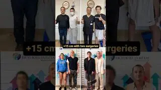 Limb Lengthening in Action: Walking Tall after a 15cm Height Gain #limblengthening