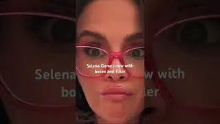 #selenagomez #haileybiebers #justinbieber #botox #botoxinjections #fillers #botched #fypシ #foryou