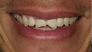 Smile Reconstruction