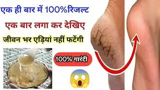 Get rid of cracked heels in 3 days!