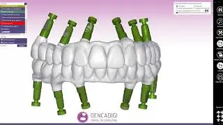 Modelo estudio sobre 6 implantes y angulaci&oacute;n 30&ordm;