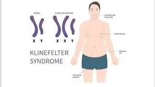 Pathology of Klinefelter Syndrome (Male Hypogonadism)