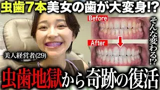 歯が腐り抜歯手術をした虫歯が７本ある美女経営者の歯の歯石チェック&ホワイトニングで大変身！？