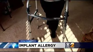 Dr. Max Gomez: Allergic Reactions To Knee Implants