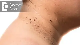 Can a skin tag turn into cancer? Are they hereditary? - Dr. Madhu SM