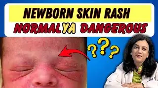 🚨Newborn Rash:Normal Ya Dangerous?Erythema Toxicum Explained!