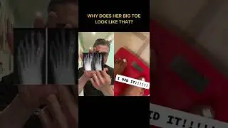 Crooked Toe FIX!?