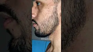 EVOLU&Ccedil;&Atilde;O MINOXIDIL - 9 MESES DE TRATAMENTO (antes e depois) #minoxidil #barba