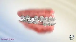 Fixing Class III Bite (Extractions)