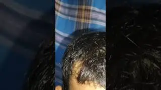 Applying #janaushadhi #minoxidil