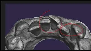 Intra Oral Scanning segmentation and its influence on Interproximal reduction for aligner treatment