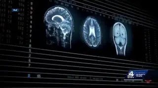 South Carolina hospital now offer breakthrough technology to reduce risk of stroke