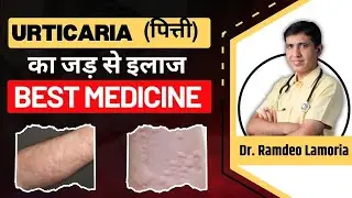 Urticaria Symptoms & Trigger Factor | पित्ती बार-बार क्यों होती है | Urticaria Homeopathy Treatment