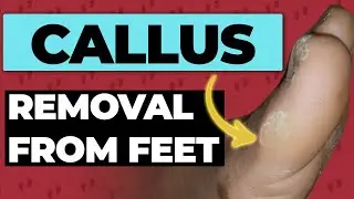 Callous Removal From Feet Using Simple Ingredients From The Pantry