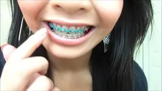 Brace Face; Month 22 | One Month Left?! | Katrina Nguyen
