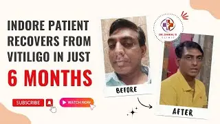 Indore Patient Recovers from Vitiligo in Just 6 Months at Dr. Danial&rsquo;s Clinic | #vitiligotreatment