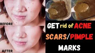 How to get rid of ACNE SCARS|How to get rid of PIMPLE MARKS|Remove pimple marks in 3 days #Lavinlove