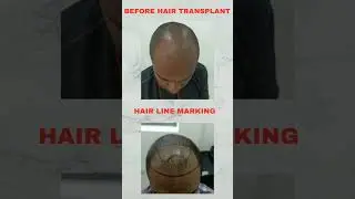 FUE HAIR TRANSPLANT @PRIME HAIR AND SKIN CLINIC/SINGANALLUR