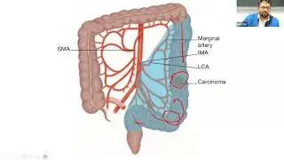 MRCS Mastering Topic Hemicolectomy, Intestinal Diversion