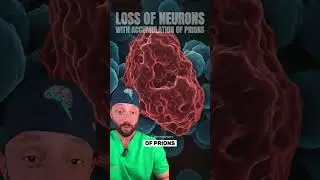 Here is how mad cow disease (bovine spongiform encephalopathy) looks like in a human. #medical
