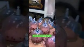 Wet cupping therapy 🌿 #hijama #cupping #neckpain
