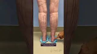 Part 1: Calf Vaser Liposuction and Forearm Reduction