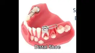 For Every Parent | Don't Let Your Child Suffer | Don't Ignore| Use Space Maintainer Dental eruption 