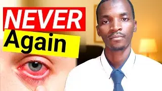 How to Avoid Getting Pink Eye