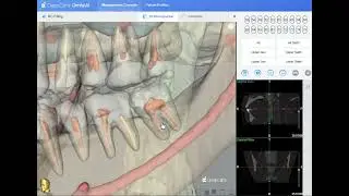 DeepCare&rsquo;s 3D Root Canal Filling Segmentation & Reconstruction